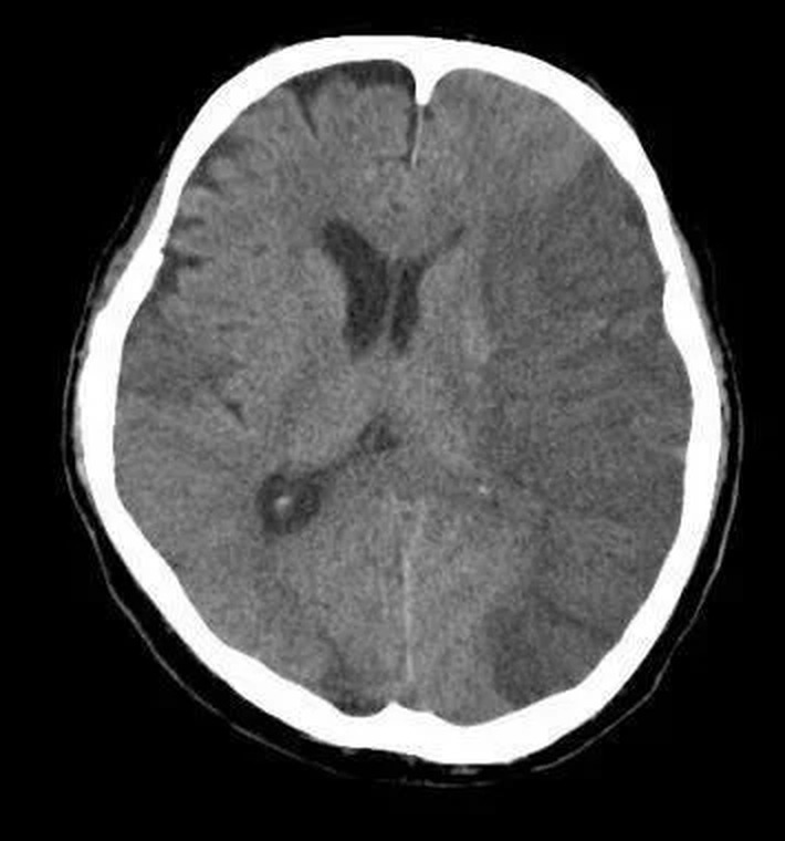 AVC Ischemic (CT nativ)