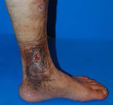 Ulcer venos și dermatită de stază