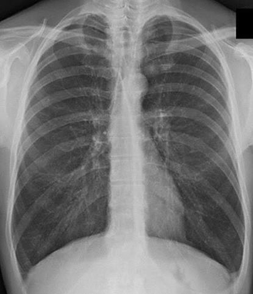 Aspectul radiologic în BPOC