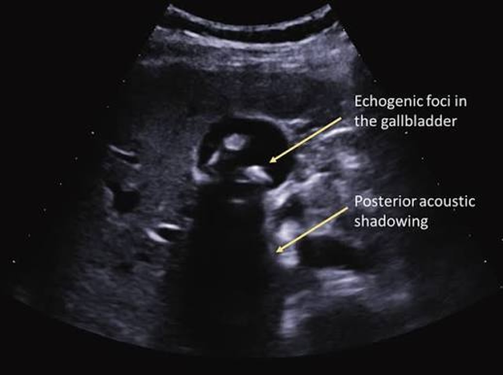 Ecografie abdominală — Colelitiază