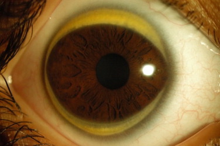 Arc cornean