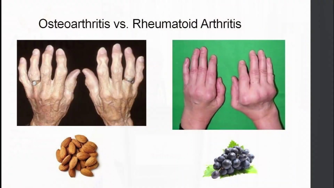 Comparație clinică: AR vs OA la nivelul mâinii