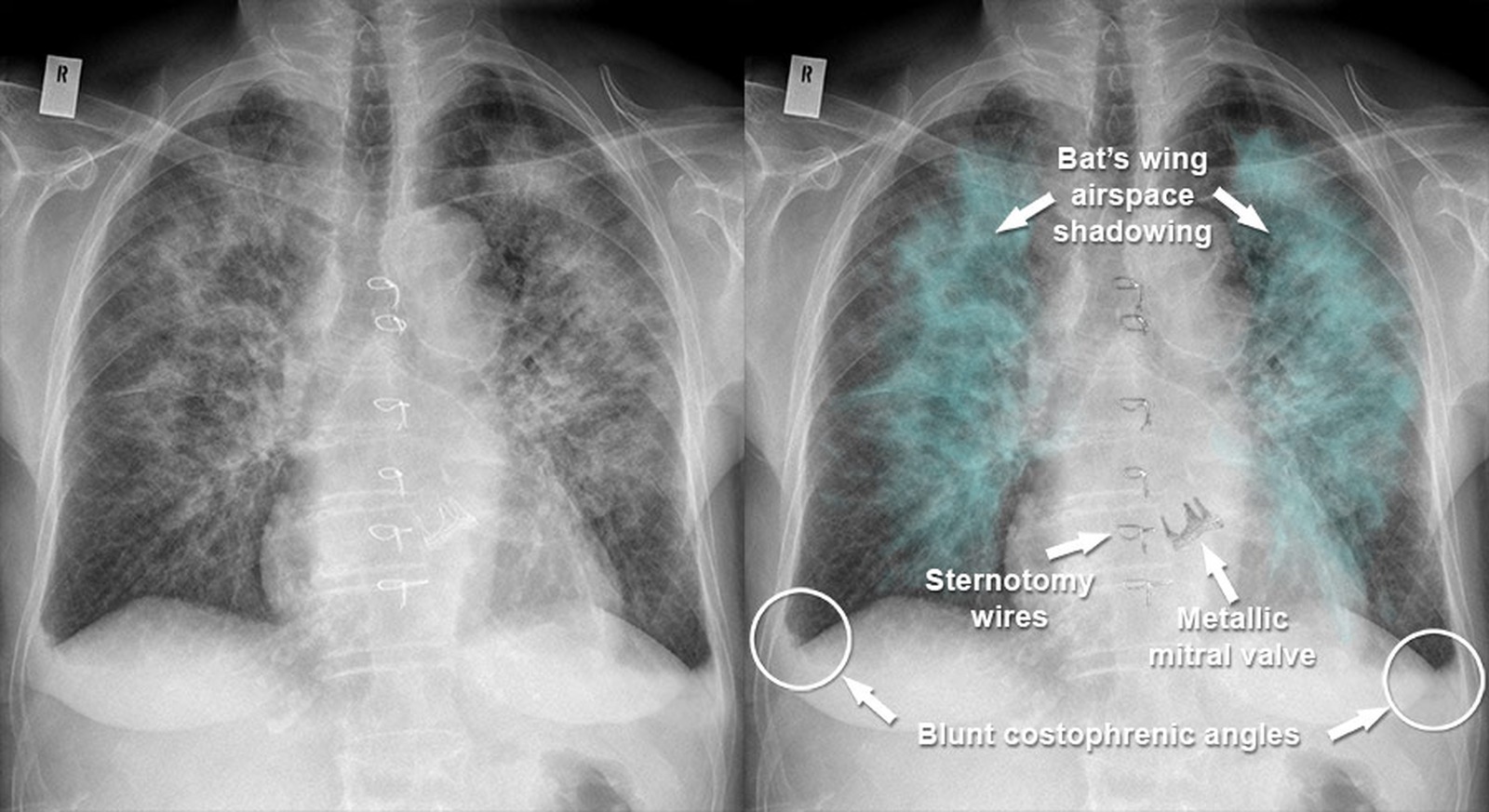 Edem alveolar (Aspect 