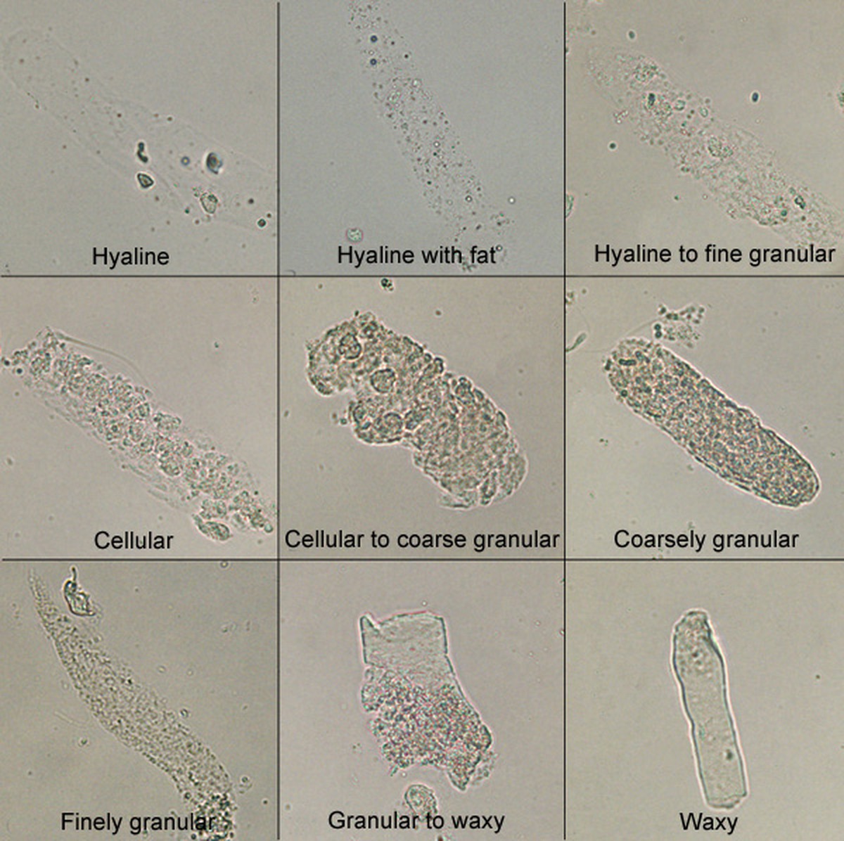 Cilindri urinari în sediment