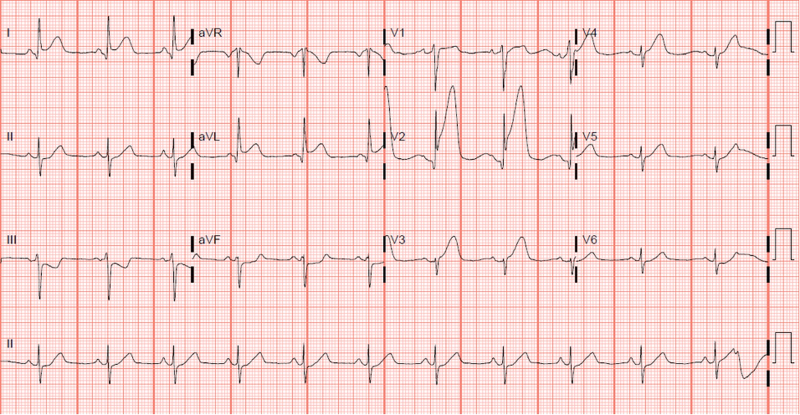 STEMI anterior