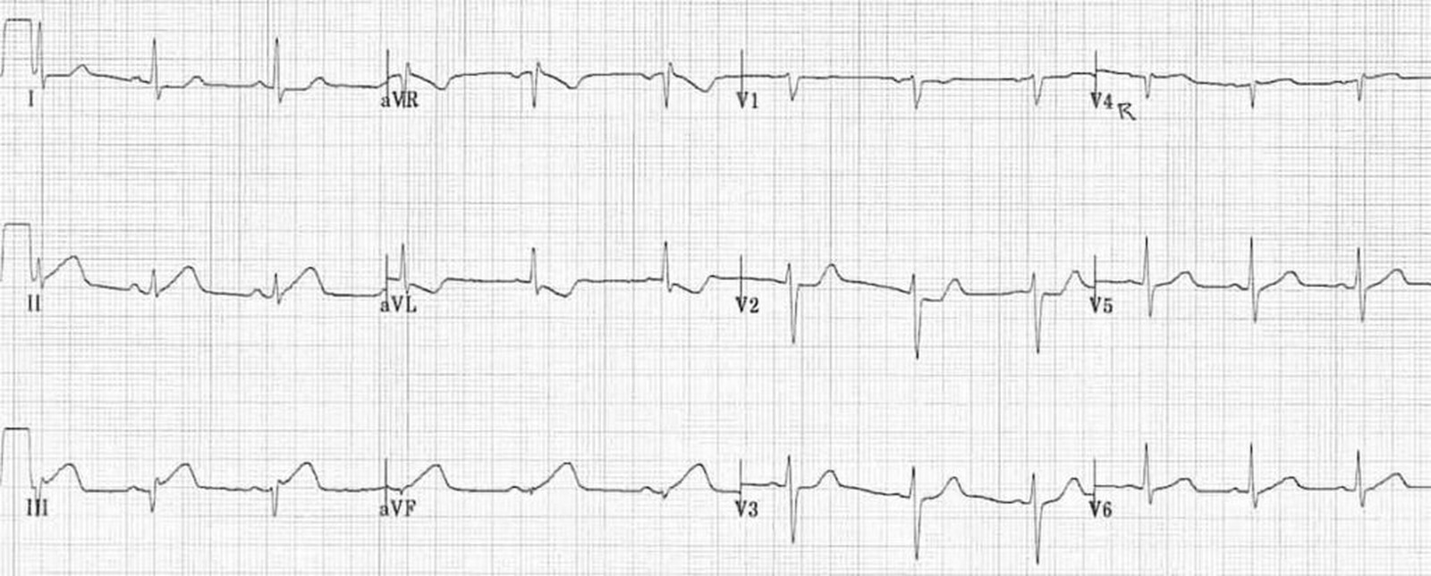 STEMI inferior