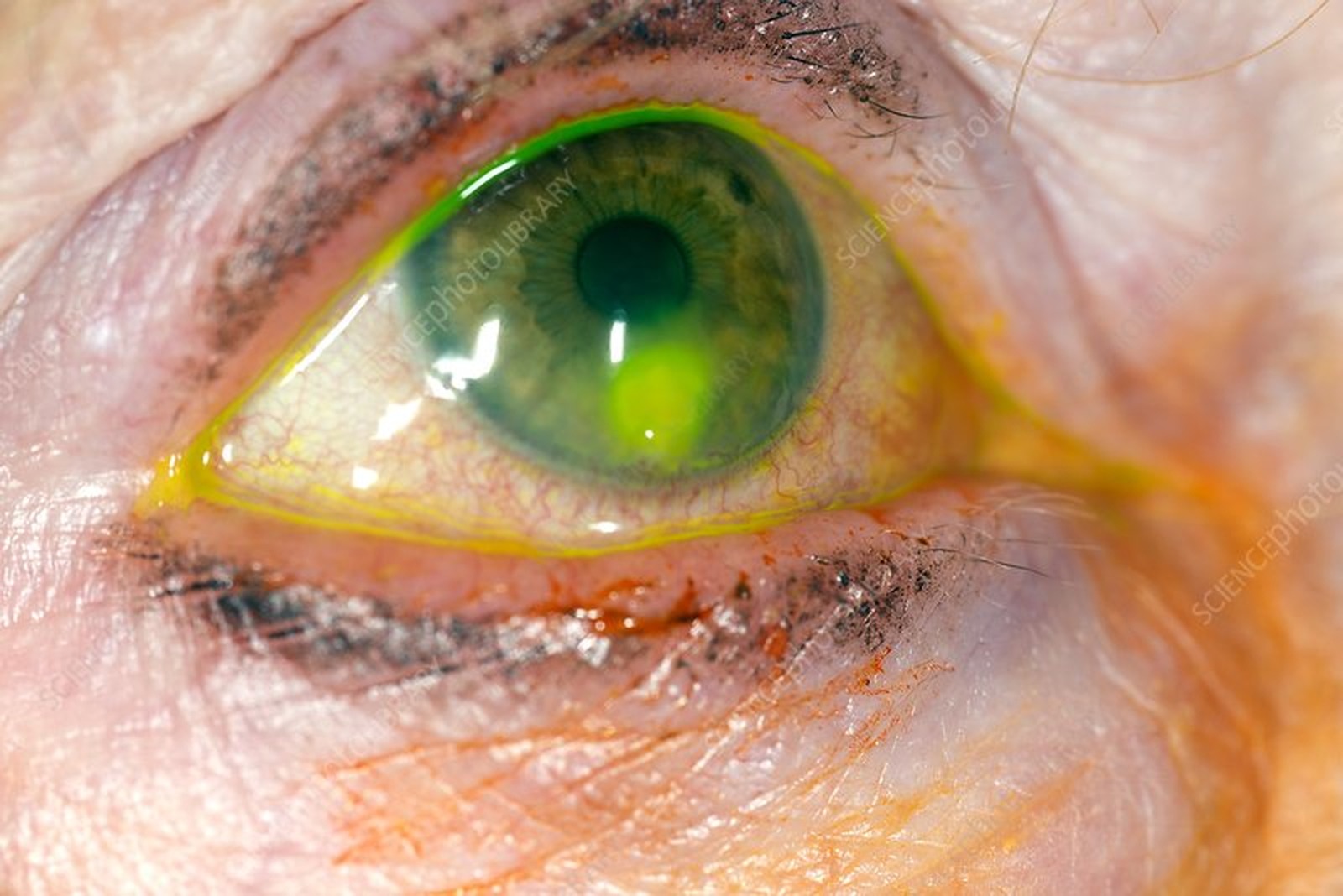 Ulcer corneean (colorație cu fluoresceină)