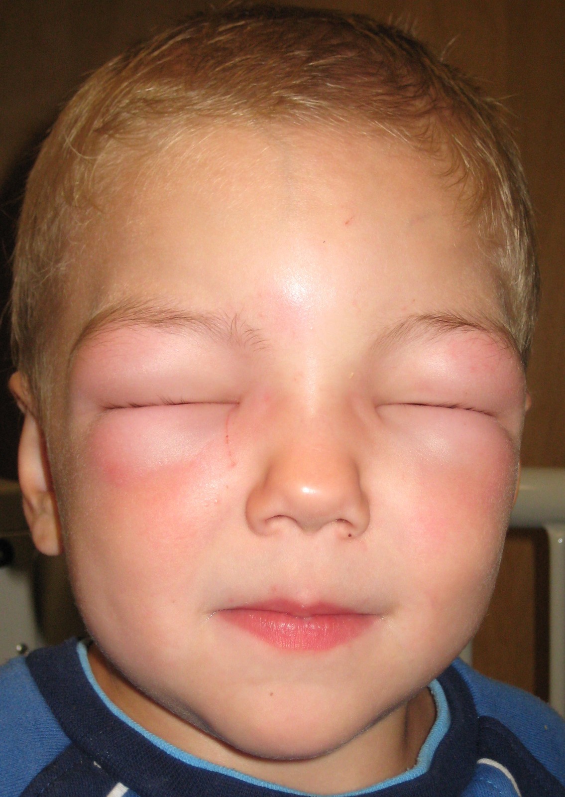 Angioedem periorbital