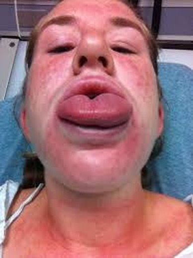 Angioedem masiv oro-facial