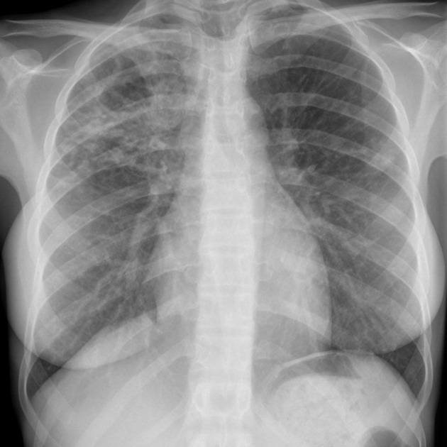 Tuberculoză pulmonară cavitară