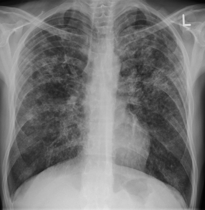 Tuberculoză miliară