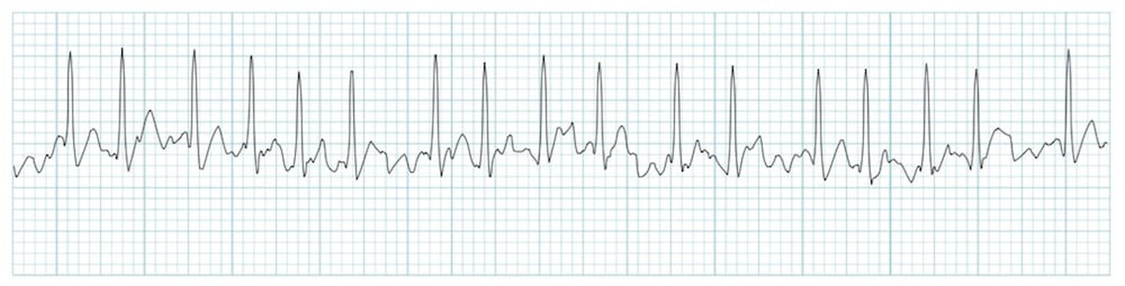 Fibrilația atrială pe ECG