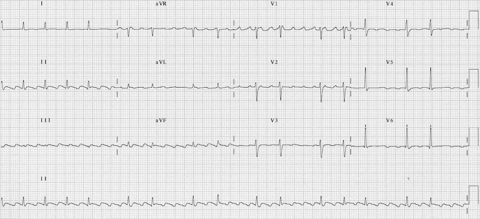 Flutter atrial pe ECG
