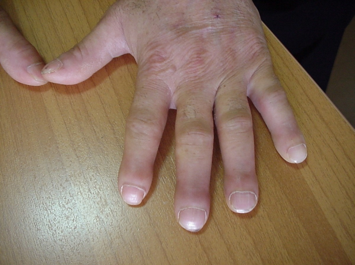 Osteoartropatie hipertrofică