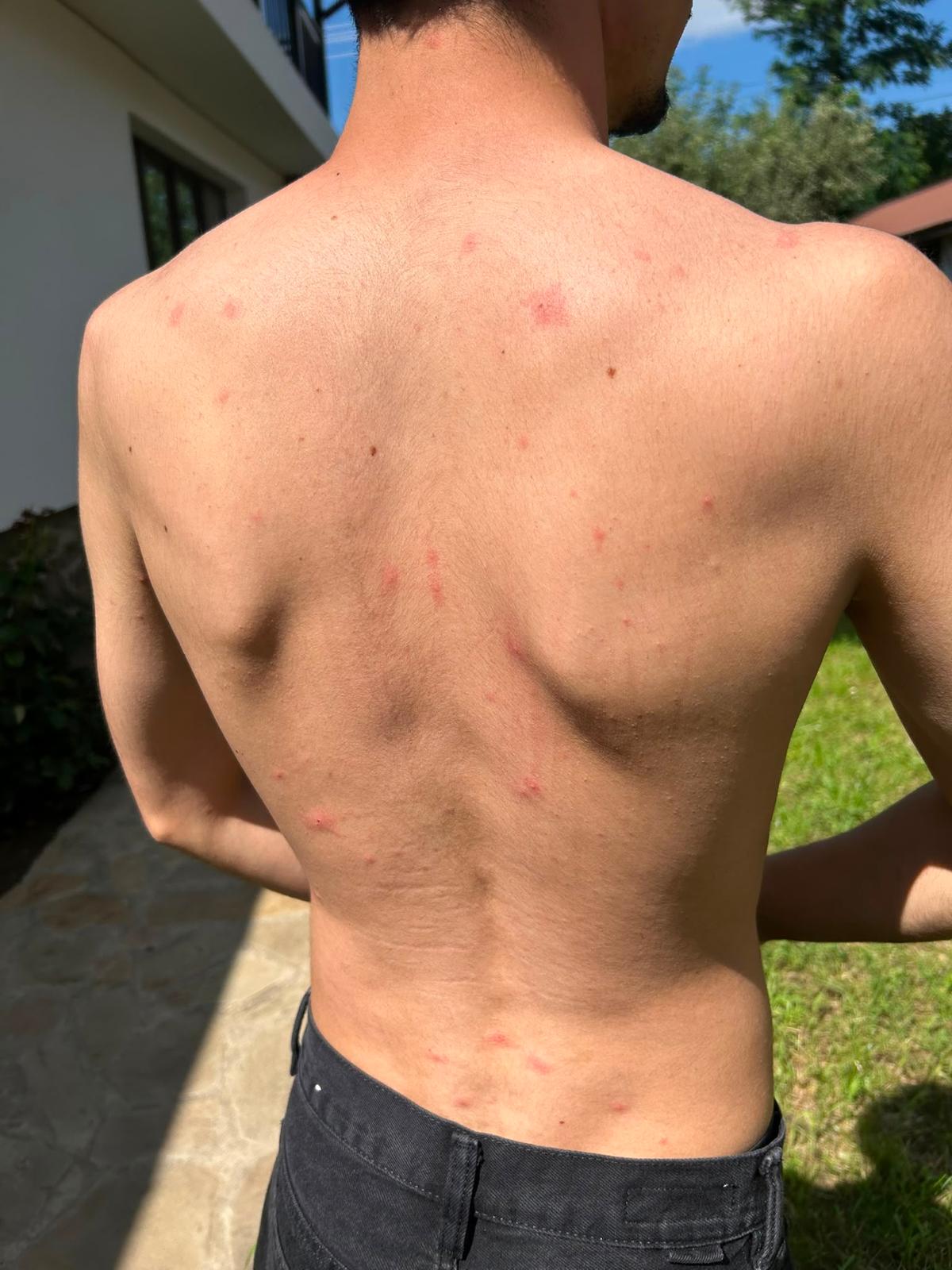 Exantem varicelos pe trunchi